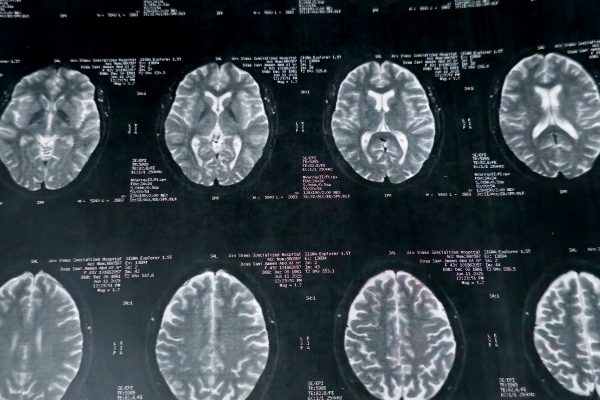 Un cerveau de quinqua dans un corps d’octogénaire, c’est possible